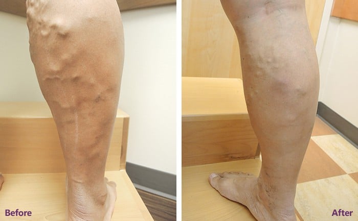 Chronic-venous-insufficiency-Before-After-Spider-and-Varicose-Vein-Treatment